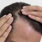 PRP Hair Treatment in Riyadh 21