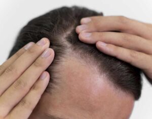 How PRP Hair Treatment Improves Hair Thickness and Strength 1 How PRP Hair Treatment Improves Hair Thickness and Strength
