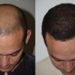 Hair transplant cost DubaiDubai