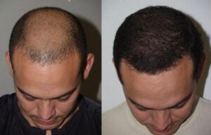 علامات تدل على مصداقية مركز زراعة الشعر في دبي 1 علامات تدل على مصداقية مركز زراعة الشعر في دبي