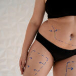 Liposuction in Dubai: Everything First-Time Patients Need to Know 3 Liposuction in Dubai: Everything First-Time Patients Need to Know