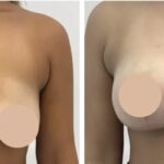Breast Reduction in Dubai: Redefining Confidence Through Expert Surgery 3 Breast Reduction in Dubai: Redefining Confidence Through Expert Surgery
