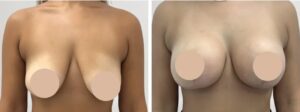 Breast Reduction in Dubai: Redefining Confidence Through Expert Surgery