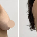 Breast Lift in Dubai with Comprehensive Patient Support