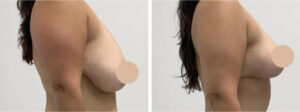 Breast Lift in Dubai with Comprehensive Patient Support 1 Breast Lift in Dubai with Comprehensive Patient Support
