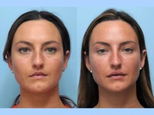 Best Plastic Surgeon in Dubai: Natural Looking Thread Lift Results Successfully 1 Best Plastic Surgeon in Dubai: Natural Looking Thread Lift Results Successfully