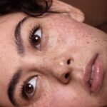 Freckles and Blemishes Treatment in Dubai88