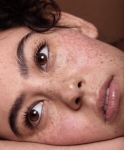 What Makes Freckles and Blemishes Treatment Effective? 1 What Makes Freckles and Blemishes Treatment Effective?