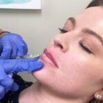 Is Restylane Effective for Smoothing Fine Facial Lines? 3 Is Restylane Effective for Smoothing Fine Facial Lines?