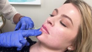 Is Restylane Effective for Smoothing Fine Facial Lines? 1 Is Restylane Effective for Smoothing Fine Facial Lines?