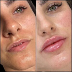 Fillers Treatment in Dubai for Safe and Effective Results 1 Fillers Treatment in Dubai for Safe and Effective Results