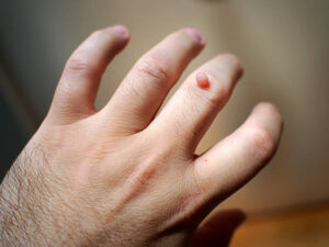 What Happens If Warts Are Left Untreated? 1 What Happens If Warts Are Left Untreated?