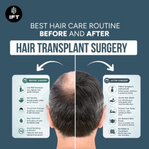 Best Hair Care Routine Before and After Hair Transplant Surgery: The Complete Recovery Guide
