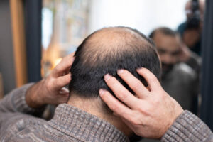 Hair Loss Treatment for Men: A Complete Guide 1 Hair Loss Treatment for Men: A Complete Guide