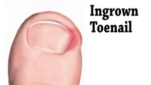 How to Prevent Ingrown Toenails with Proper Footcare 1 How to Prevent Ingrown Toenails with Proper Footcare