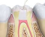 5 Things to Know Before Getting Root Canal Treatment 3 5 Things to Know Before Getting Root Canal Treatment