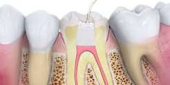 5 Things to Know Before Getting Root Canal Treatment 1 5 Things to Know Before Getting Root Canal Treatment