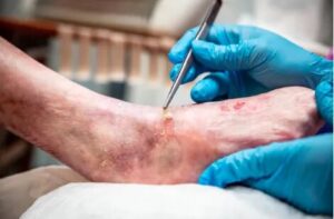 What Happens If a Diabetic Foot Wound Is Left Untreated Too Long?