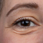 Eye Bag Removal in Riyadh 9