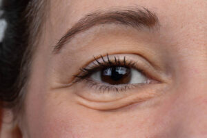 Understanding Recovery After an Eye Bag Removal Procedure 1 Understanding Recovery After an Eye Bag Removal Procedure