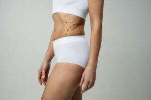 Liposuction Surgery in Dubai Why Technique Matters for Better Results 1 Liposuction Surgery in Dubai Why Technique Matters for Better Results