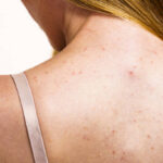 Top Remedies for Back Acne in Riyadh 3 Top Remedies for Back Acne in Riyadh