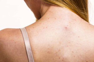 Top Remedies for Back Acne in Riyadh 1 Top Remedies for Back Acne in Riyadh