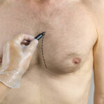 Recovery Tips and Aftercare Following Gynecomastia Surgery