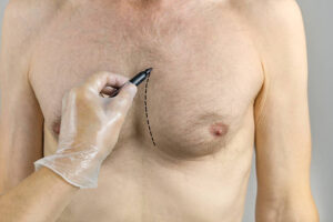 Recovery Tips and Aftercare Following Gynecomastia Surgery 1 Recovery Tips and Aftercare Following Gynecomastia Surgery