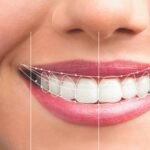 Smile design treatment ajj