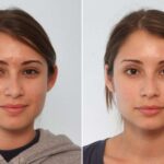 otoplasty
