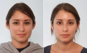 Ear Surgery (Otoplasty) Cost in Lahore, Pakistan 1 Ear Surgery (Otoplasty) Cost in Lahore, Pakistan