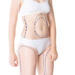 Liposuction for Abdomen and Waist Contouring