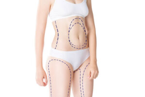 Liposuction for Abdomen and Waist Contouring 1 Liposuction for Abdomen and Waist Contouring
