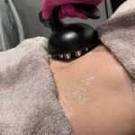 How Much Does a CoolSculpting Treatment Cost in Edmonton
