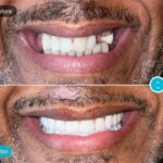 Best Dental Implants Mumbai for a Confident, Natural Smile