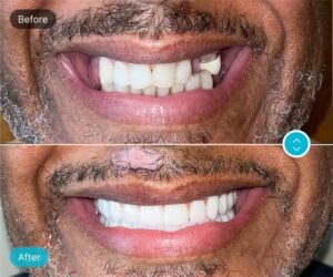 Best Dental Implants Mumbai for a Confident, Natural Smile 105 Best Dental Implants Mumbai for a Confident, Natural Smile
