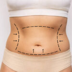 Understanding Liposuction for the Back and Flanks