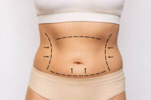 Understanding Liposuction for the Back and Flanks