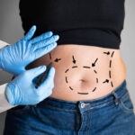 Tummy Tuck in Riyadh 41