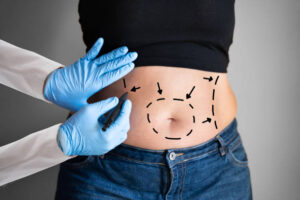 How to Choose the Right Tummy Tuck Approach for You
