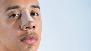 Limited Offer! Rhinoplasty offer in Riyadh for a Limited Period