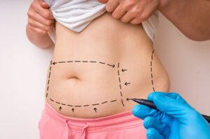 How Long Do Mommy Makeover Results Last?