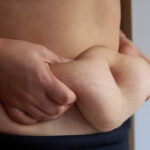 Tummy Tuck offer in Riyadh 18