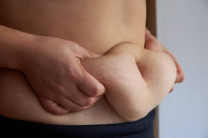 Limited Offer! Tummy Tuck Discounts in Riyadh for a Limited Period