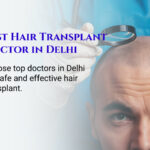 How to Find a Trusted Hair Transplant Doctor in Delhi for Natural Results