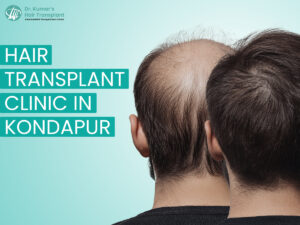 Everything You Should Know Before Getting a Hair Transplant in Kondapur 1 Everything You Should Know Before Getting a Hair Transplant in Kondapur