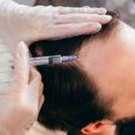 Magellan Plasma for Early Signs of Hair Thinning