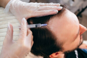 Magellan Plasma for Early Signs of Hair Thinning