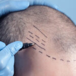 Non incisional hair transplant